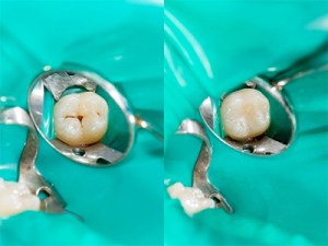 How Do Dental Sealants Work?
