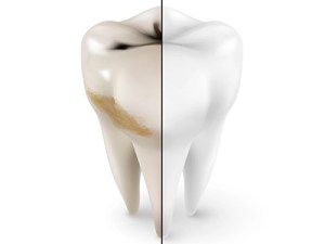 What are Dental Sealants?