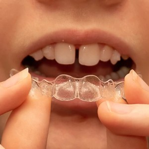 Is Invisalign suitable for children