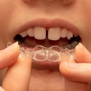 Is Invisalign A Permanent Fix