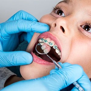 Which is Faster – Braces or Invisalign