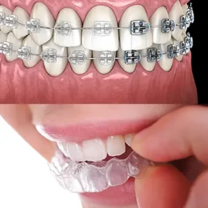 Invisalign vs Braces For Kids