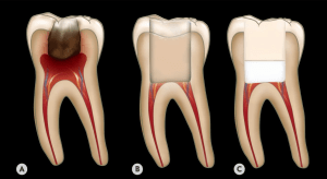 Will My Child Be In Pain After A Pulpotomy